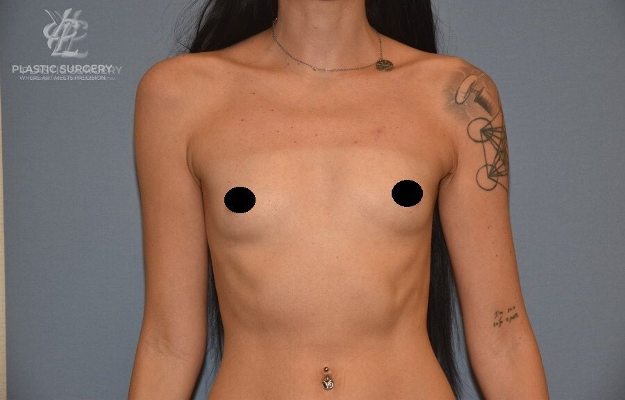 Breast Augmentation, patient 7, before, view 1