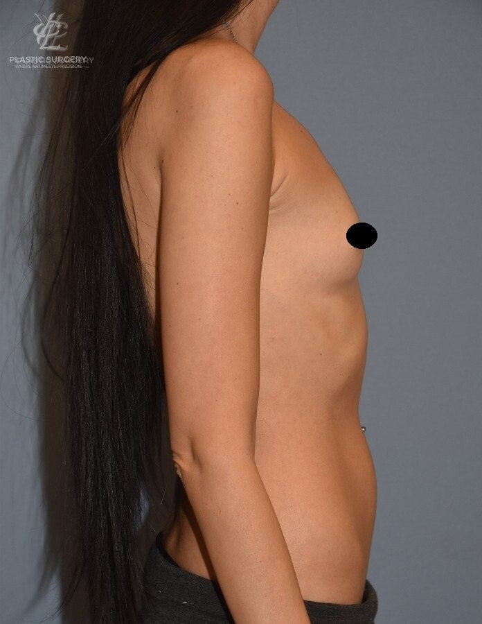 Breast Augmentation, patient 7, before, view 3