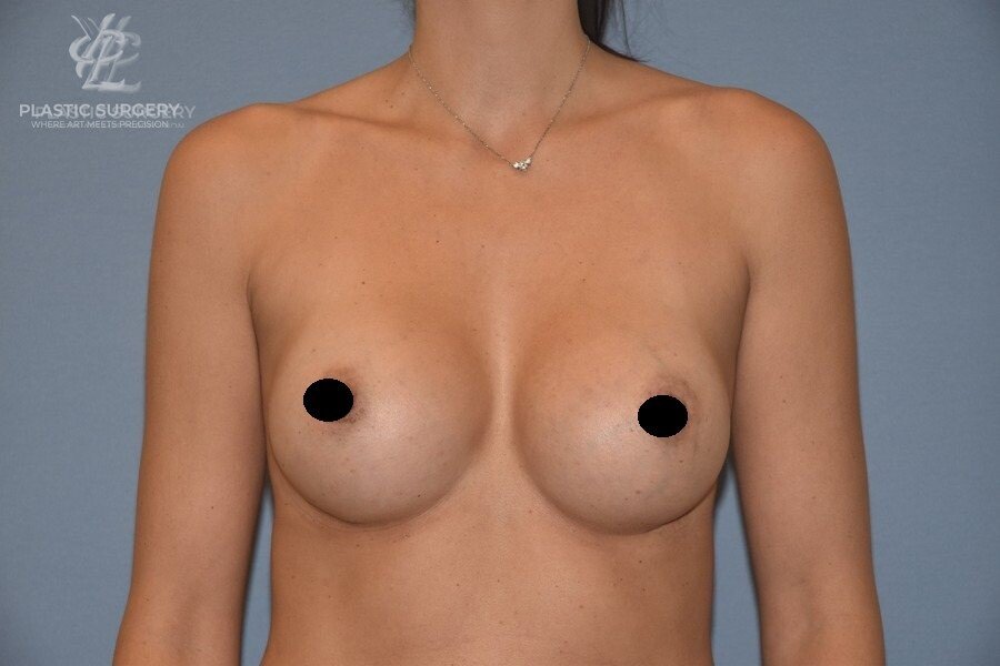 Breast Augmentation, patient 8, after, view 1