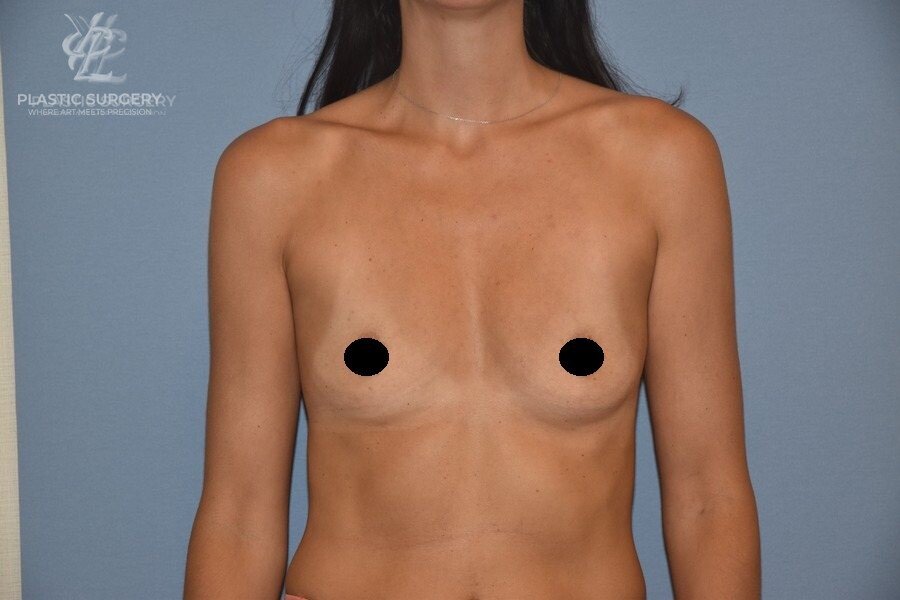 Breast Augmentation, patient 8, before, view 1