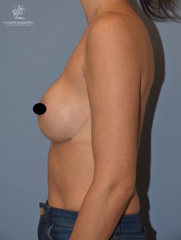 Breast Augmentation, patient 8, after, view 3