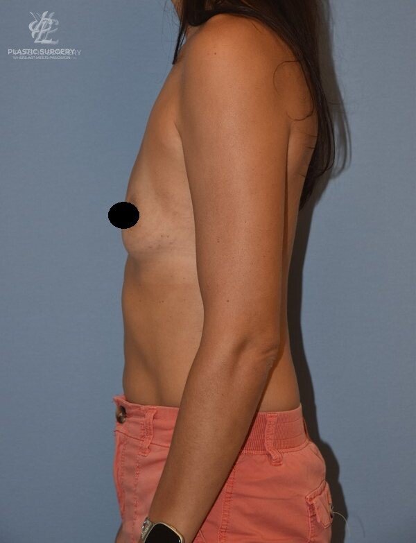 Breast Augmentation, patient 8, before, view 3