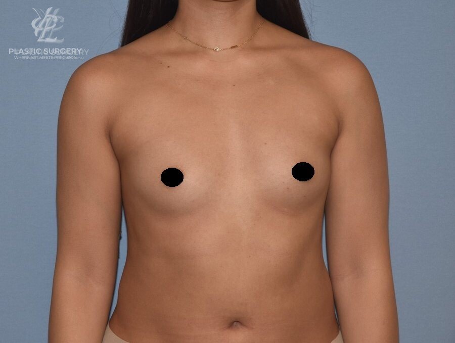 Breast Augmentation, patient 9, before, view 1