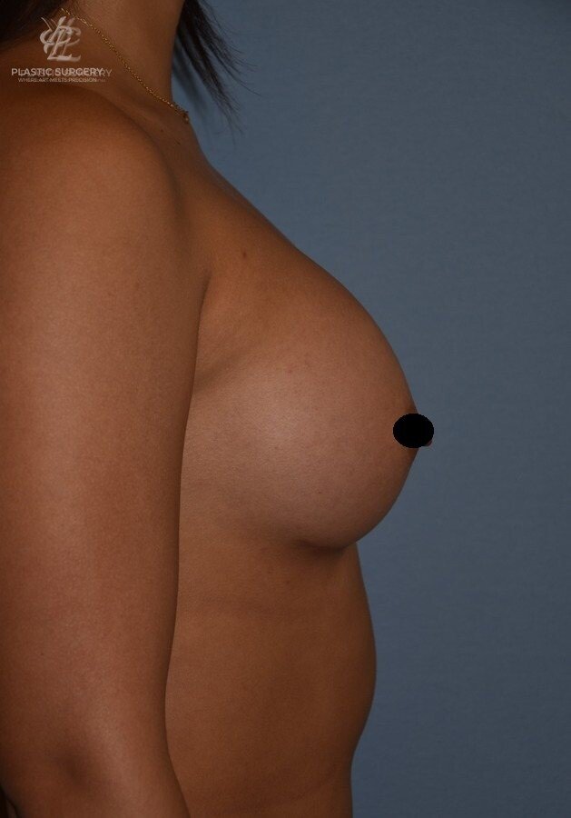 Breast Augmentation, patient 9, after, view 3