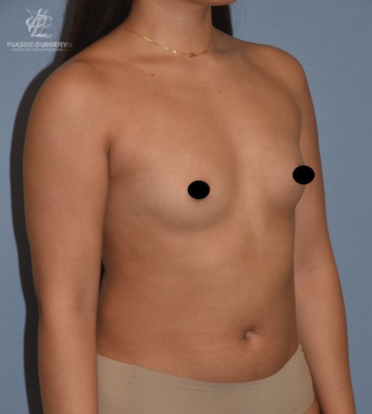 Breast Augmentation, patient 9, before, view 2