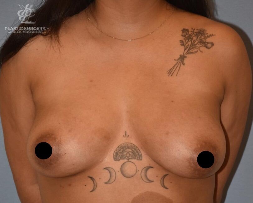 Breast Fat Grafting, patient 1, after, view 1