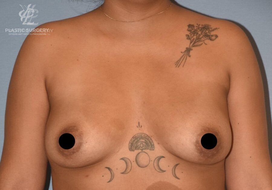 Breast Fat Grafting, patient 1, before, view 1