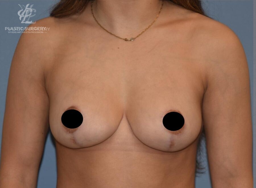 Breast Lift (Mastopexy), patient 1, after, view 1