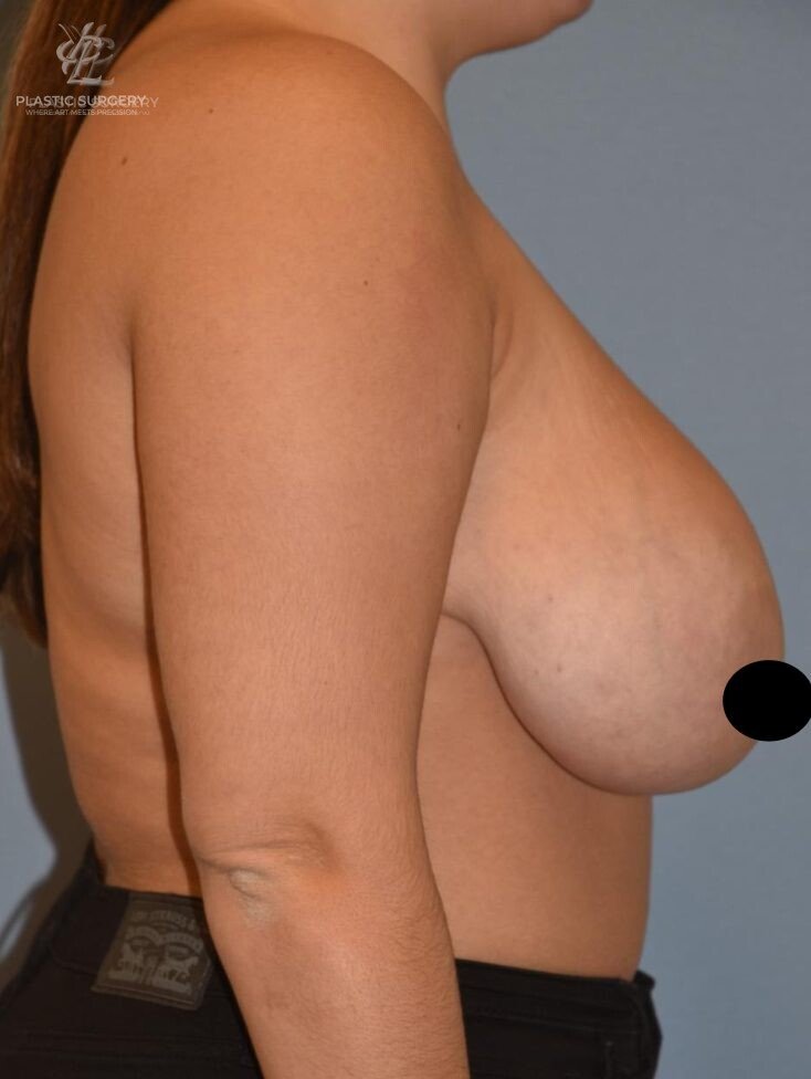 Breast Lift (Mastopexy), patient 2, before, view 3
