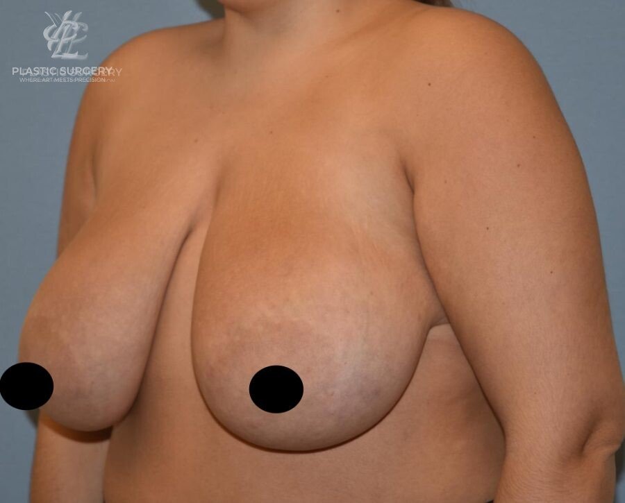 Breast Lift (Mastopexy), patient 2, before, view 2