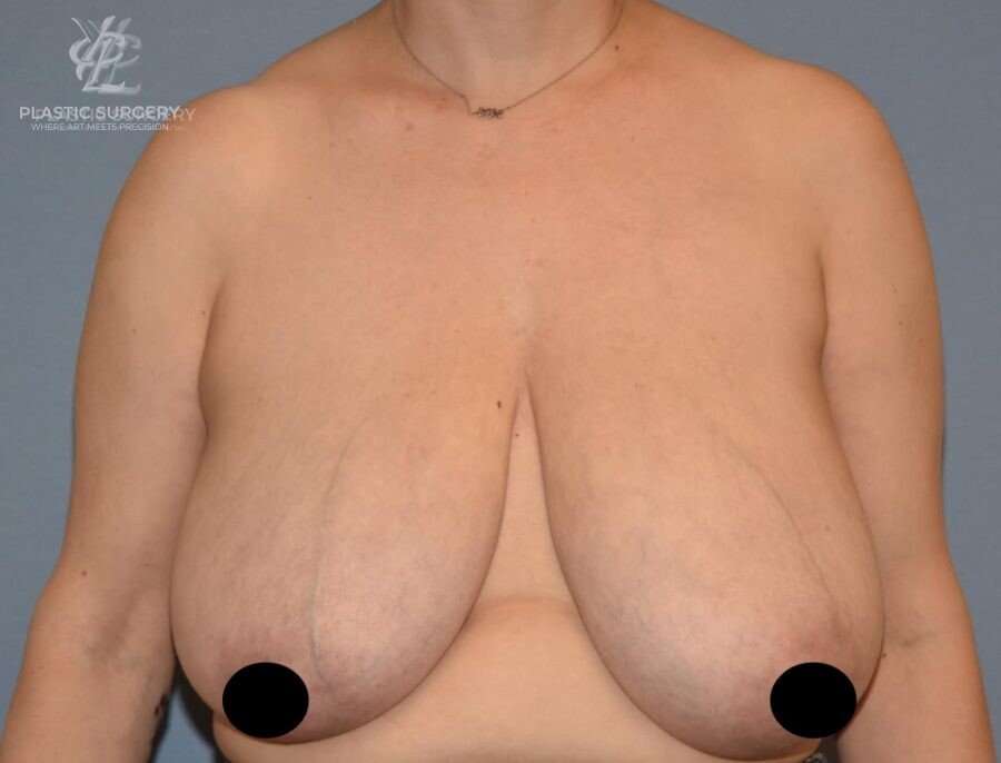 Breast Lift (Mastopexy), patient 3, before, view 1