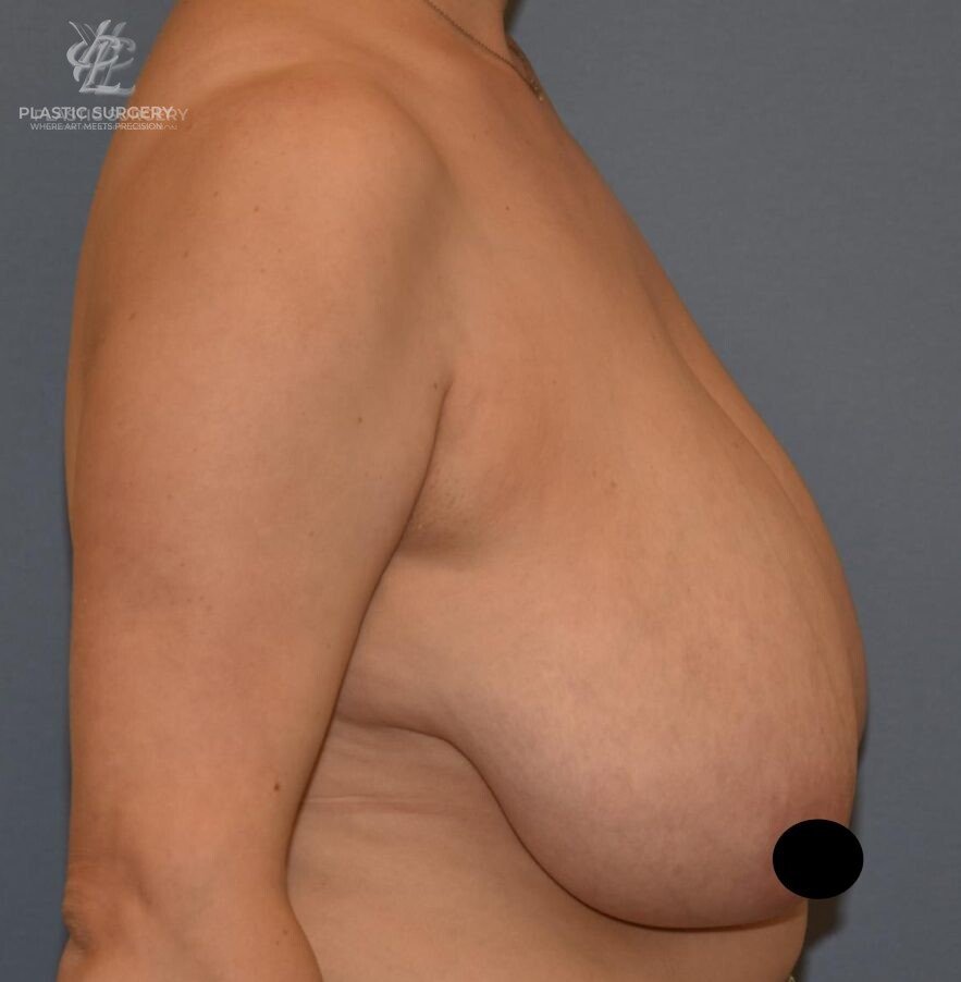 Breast Lift (Mastopexy), patient 3, before, view 3