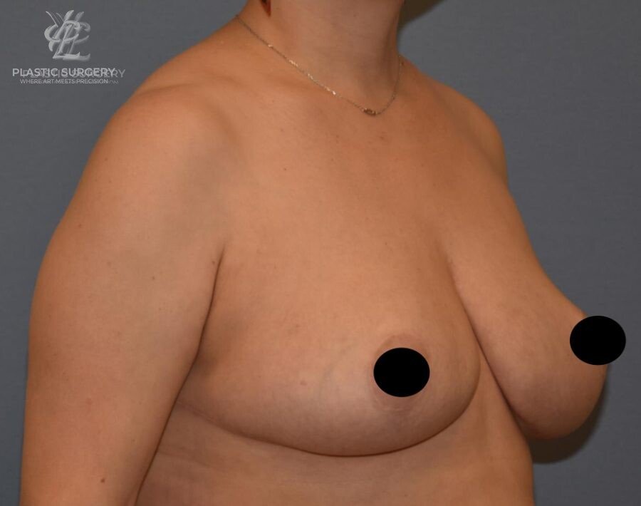 Breast Lift (Mastopexy), patient 3, after, view 2