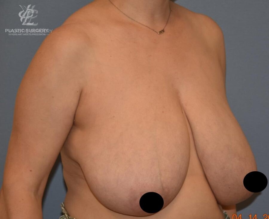 Breast Lift (Mastopexy), patient 3, before, view 2