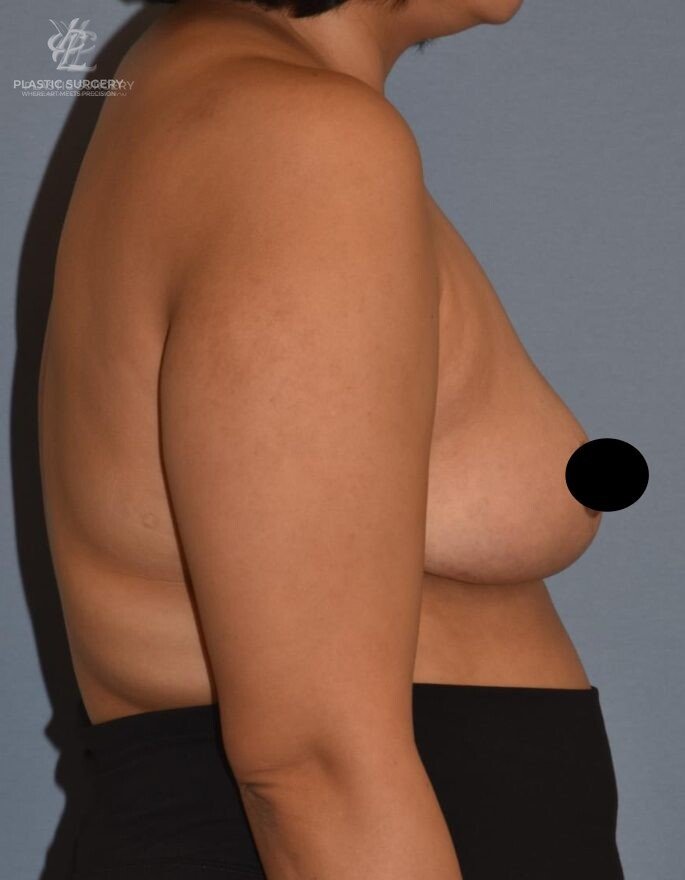 Breast Lift (Mastopexy), patient 4, after, view 3