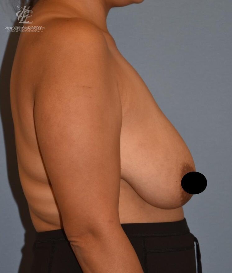 Breast Lift (Mastopexy), patient 4, before, view 3