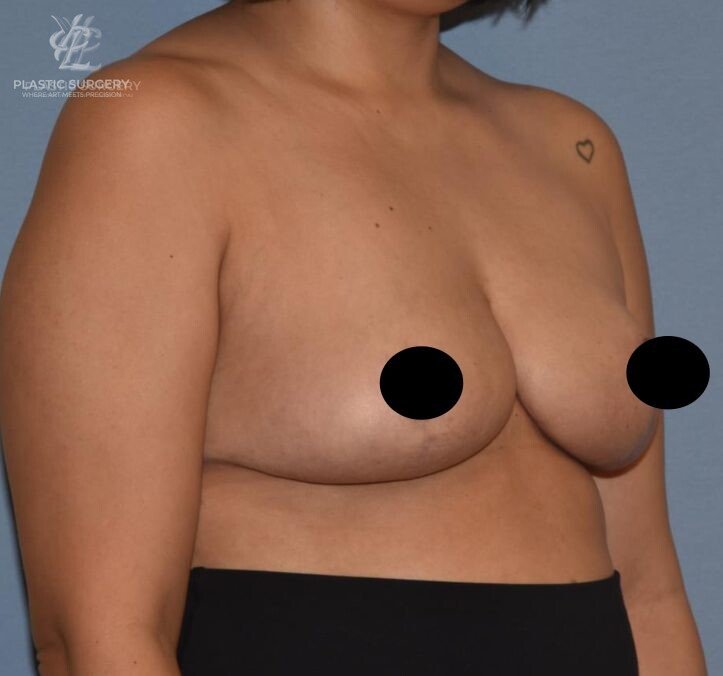 Breast Lift (Mastopexy), patient 4, after, view 2