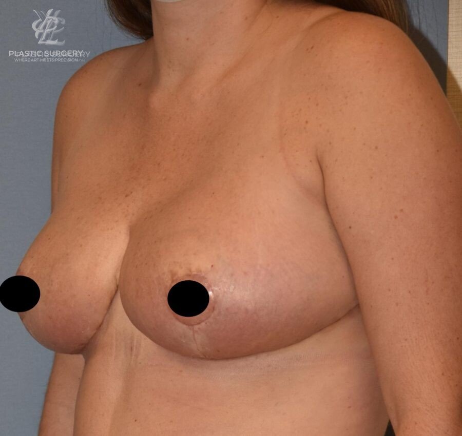 Breast Lift (Mastopexy), patient 5, after, view 2