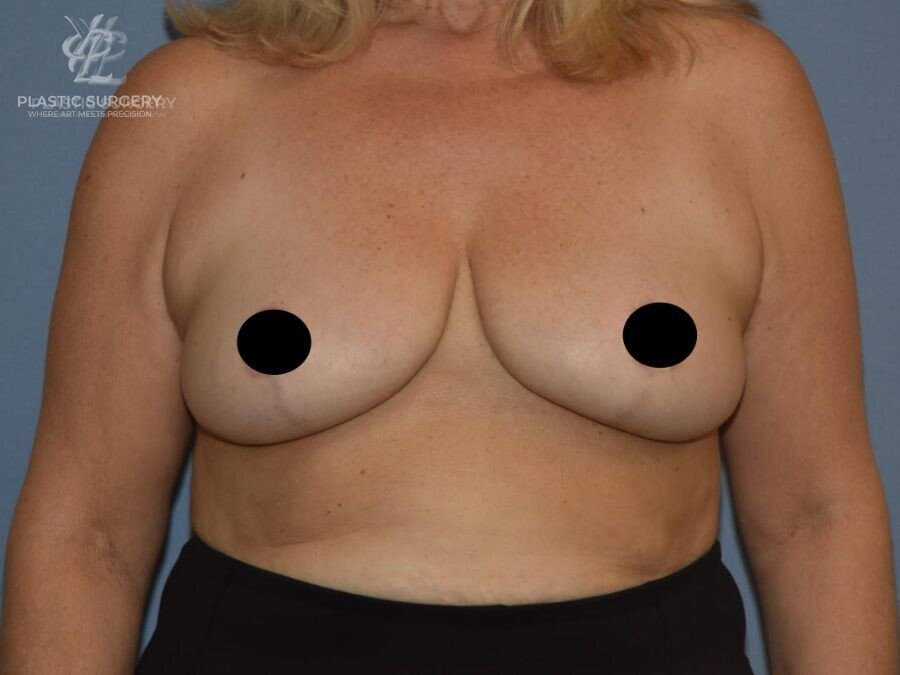 Breast Lift (Mastopexy), patient 7, after, view 1