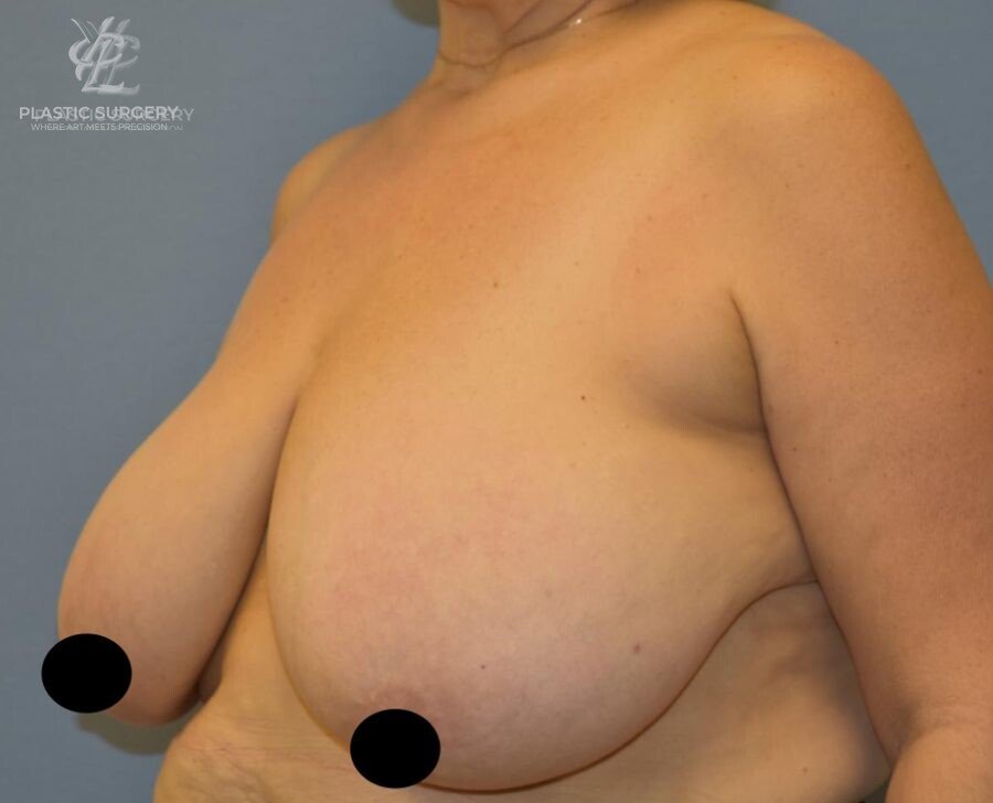 Breast Lift (Mastopexy), patient 7, before, view 2