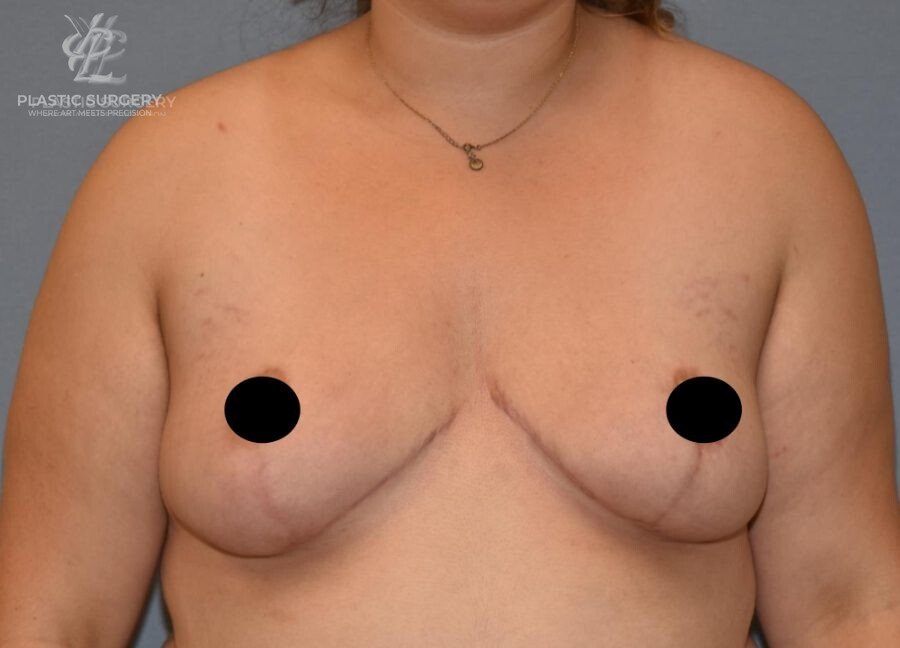 Breast Lift (Mastopexy), patient 9, after, view 1