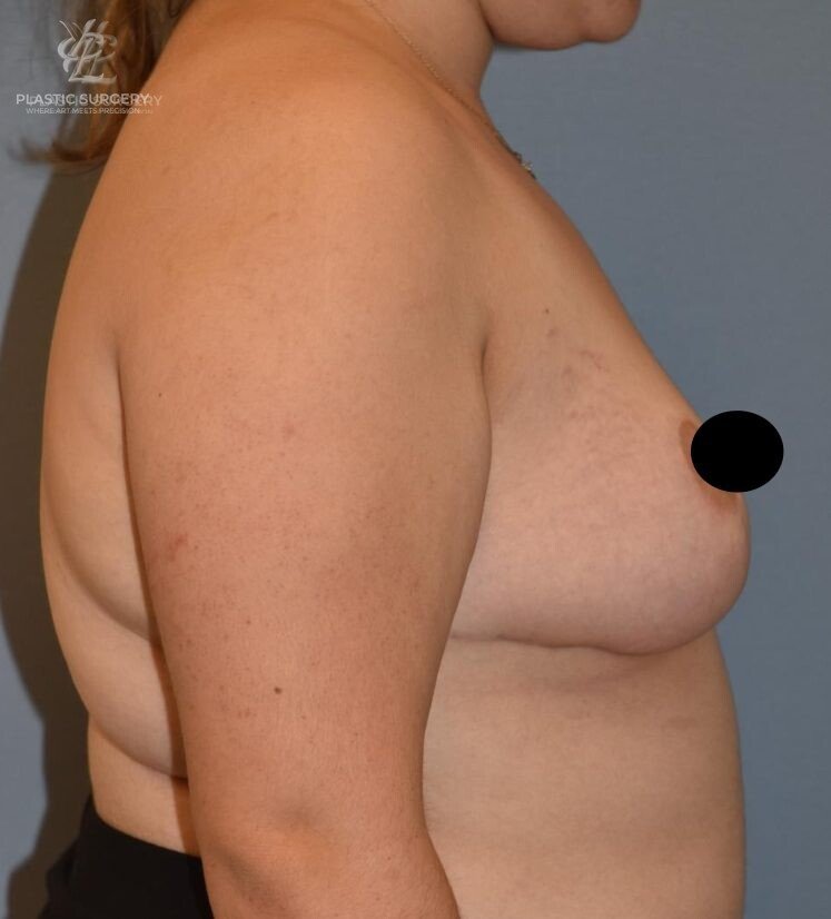 Breast Lift (Mastopexy), patient 9, after, view 3