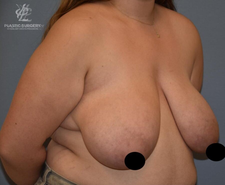 Breast Lift (Mastopexy), patient 9, before, view 2