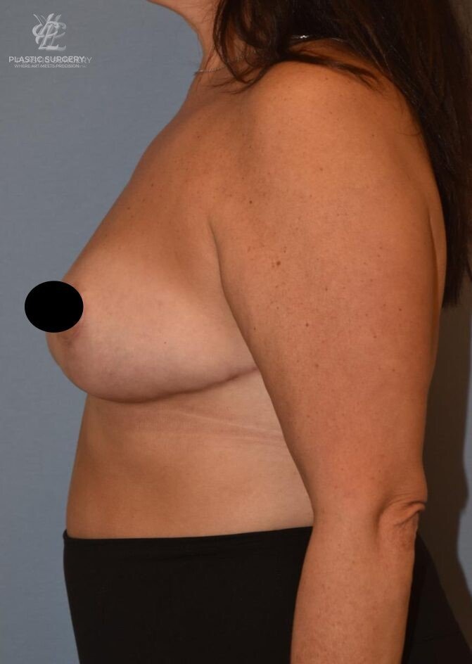 Breast Lift (Mastopexy), patient 10, after, view 3