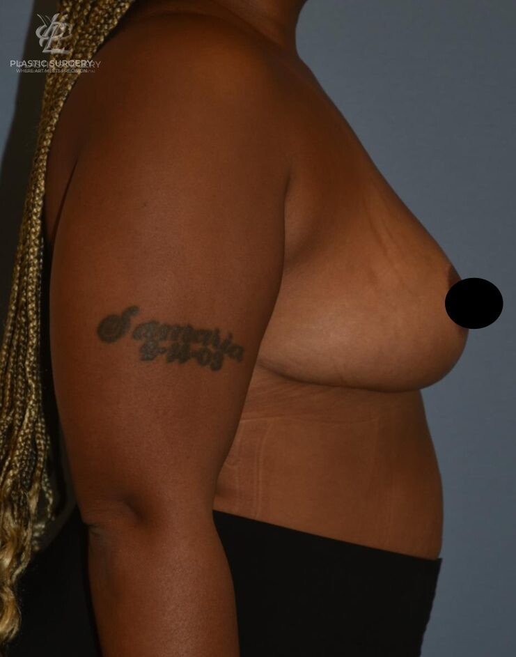 Breast Lift (Mastopexy), patient 11, after, view 3