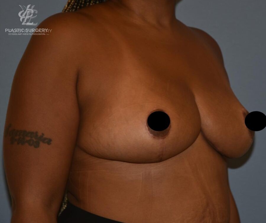 Breast Lift (Mastopexy), patient 11, after, view 2