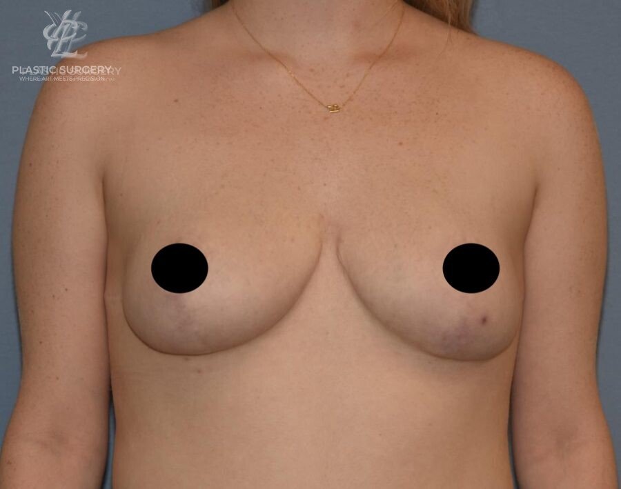 Breast Lift (Mastopexy), patient 12, after, view 1