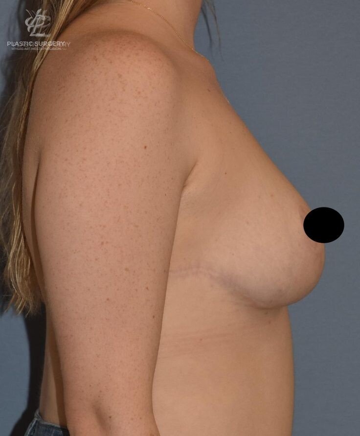 Breast Lift (Mastopexy), patient 12, after, view 3