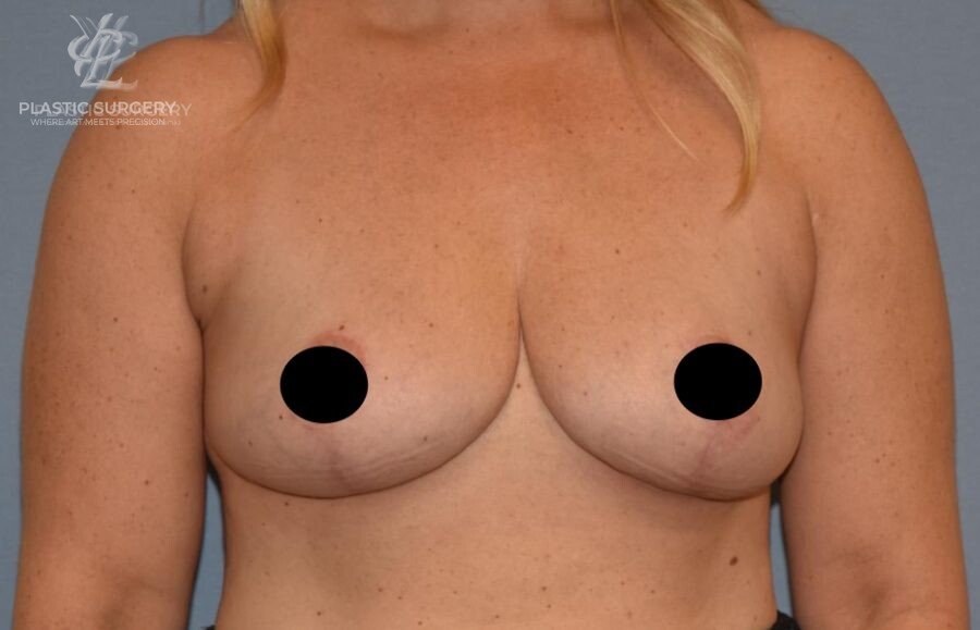 Breast Lift (Mastopexy), patient 13, after, view 1