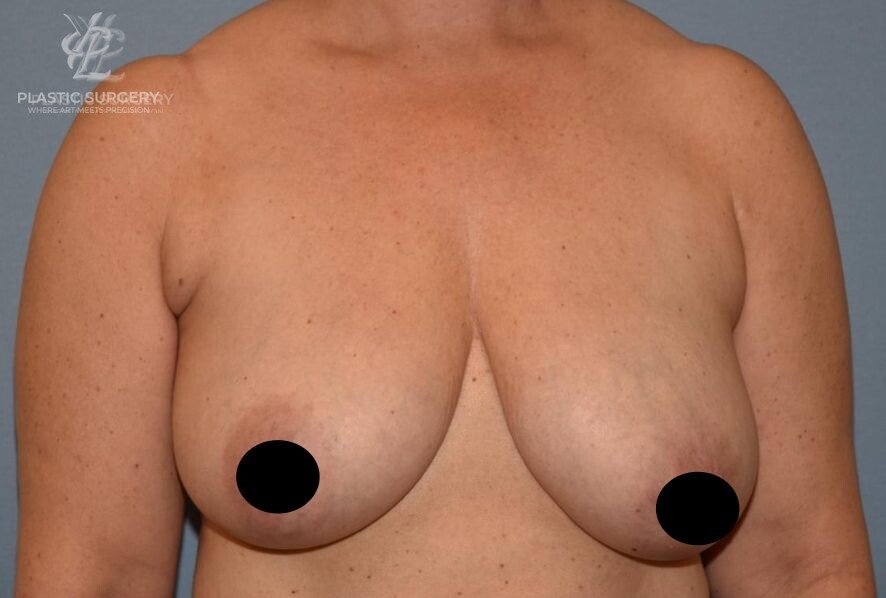 Breast Lift (Mastopexy), patient 13, before, view 1