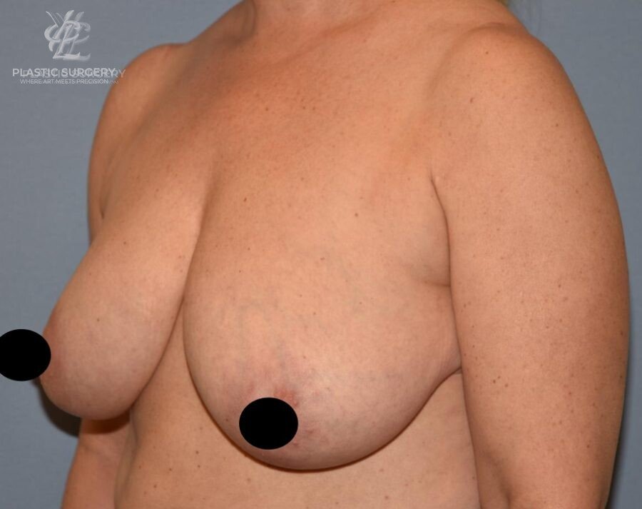 Breast Lift (Mastopexy), patient 13, before, view 2
