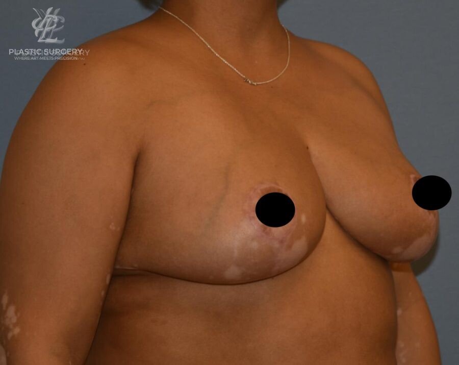 Breast Lift (Mastopexy), patient 14, after, view 2