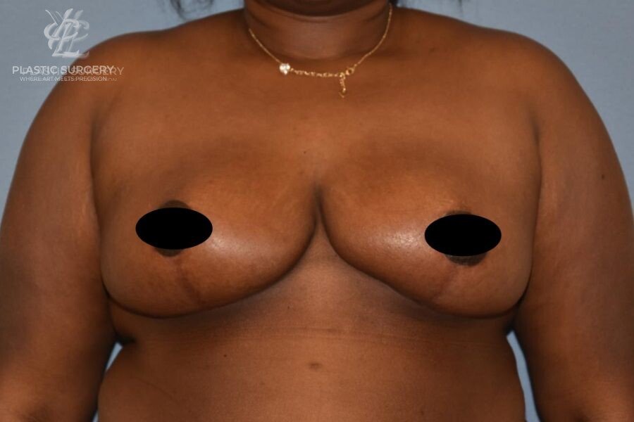 Breast Reduction, patient 1, after, view 1