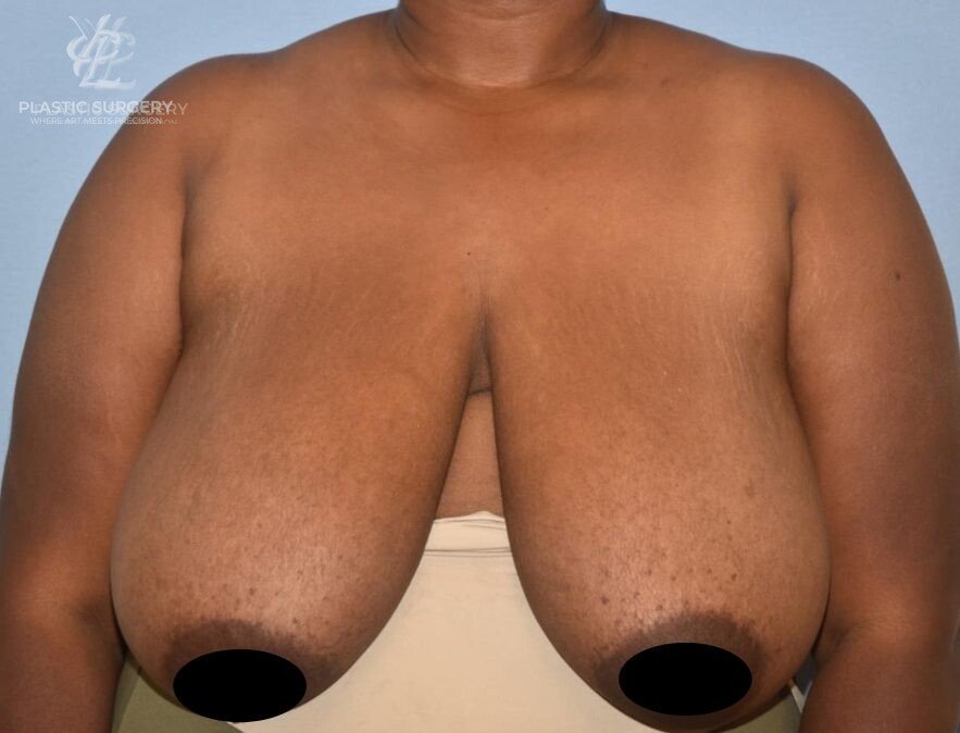 Breast Reduction, patient 1, before, view 1