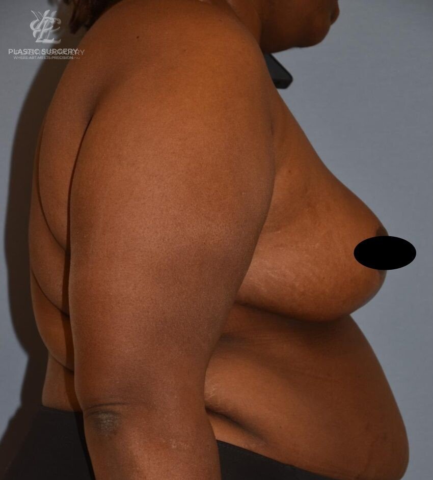 Breast Reduction, patient 1, after, view 3