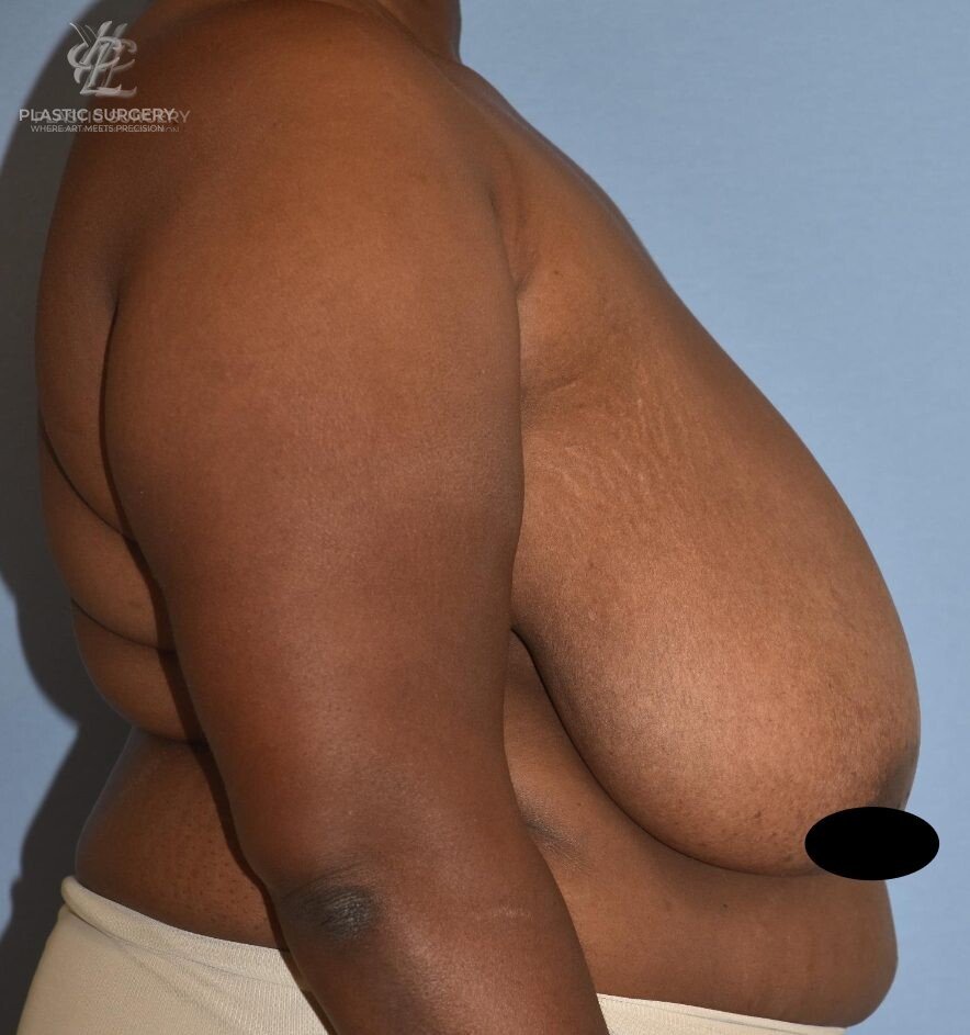 Breast Reduction, patient 1, before, view 3
