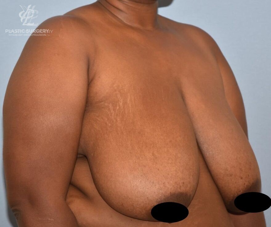 Breast Reduction, patient 1, before, view 2