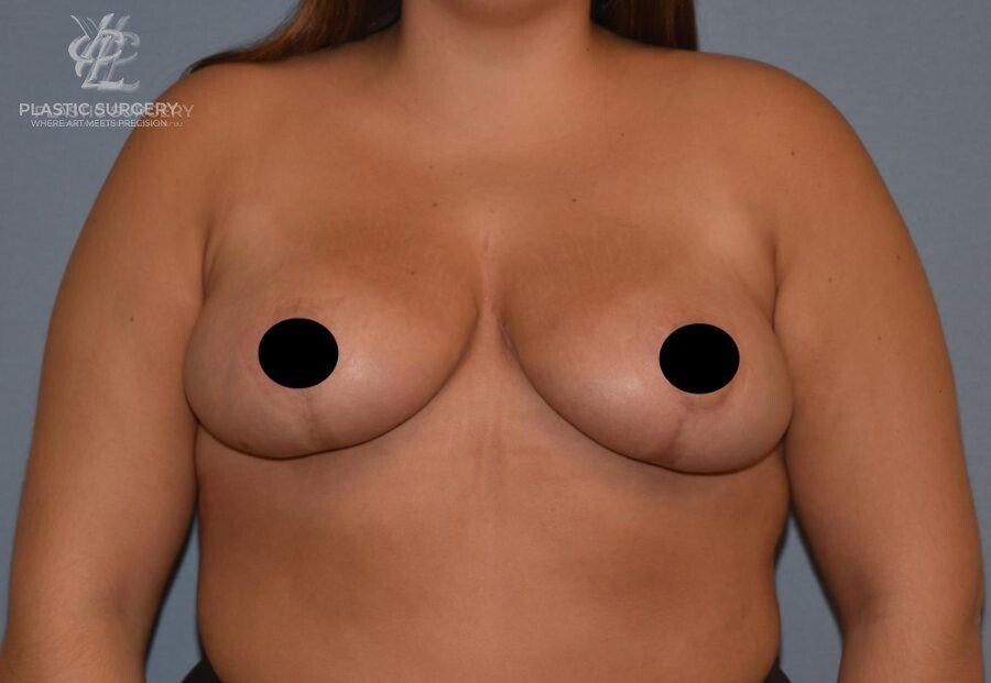 Breast Reduction, patient 3, after, view 1