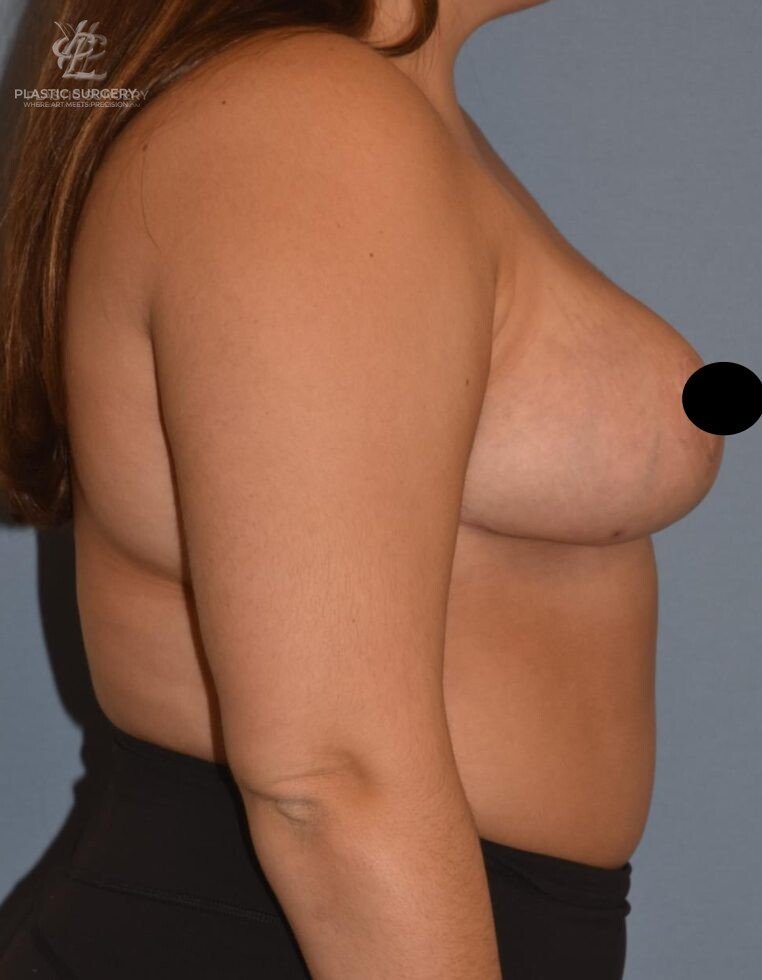 Breast Reduction, patient 3, after, view 3