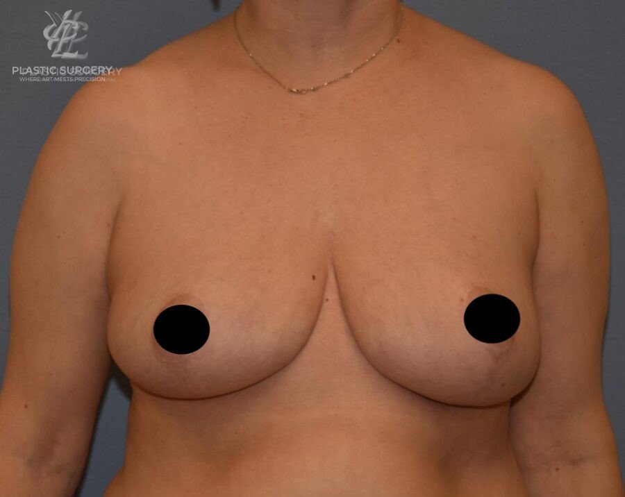 Breast Reduction, patient 4, after, view 1