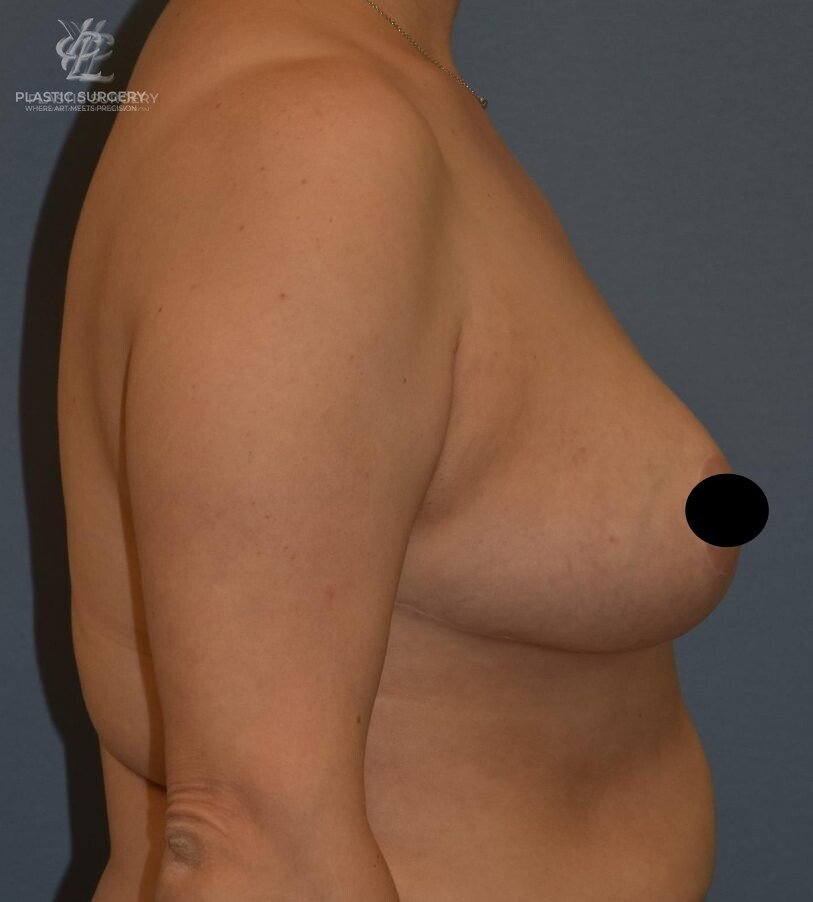 Breast Reduction, patient 4, after, view 3