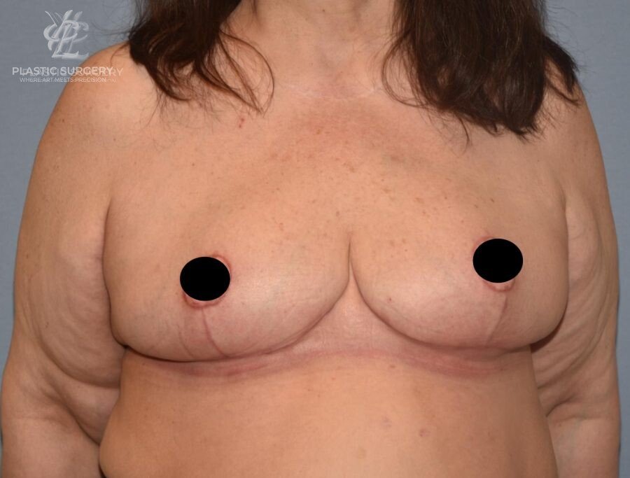 Breast Reduction, patient 5, after, view 1