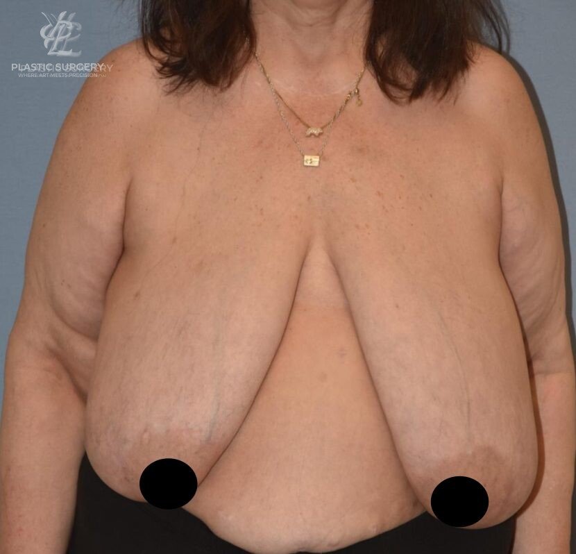Breast Reduction, patient 5, before, view 1