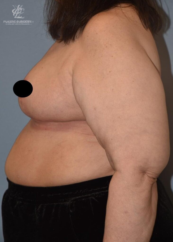 Breast Reduction, patient 5, after, view 3