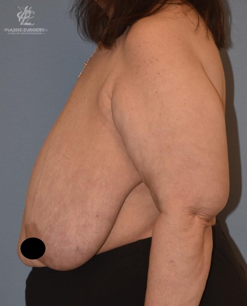 Breast Reduction, patient 5, before, view 3