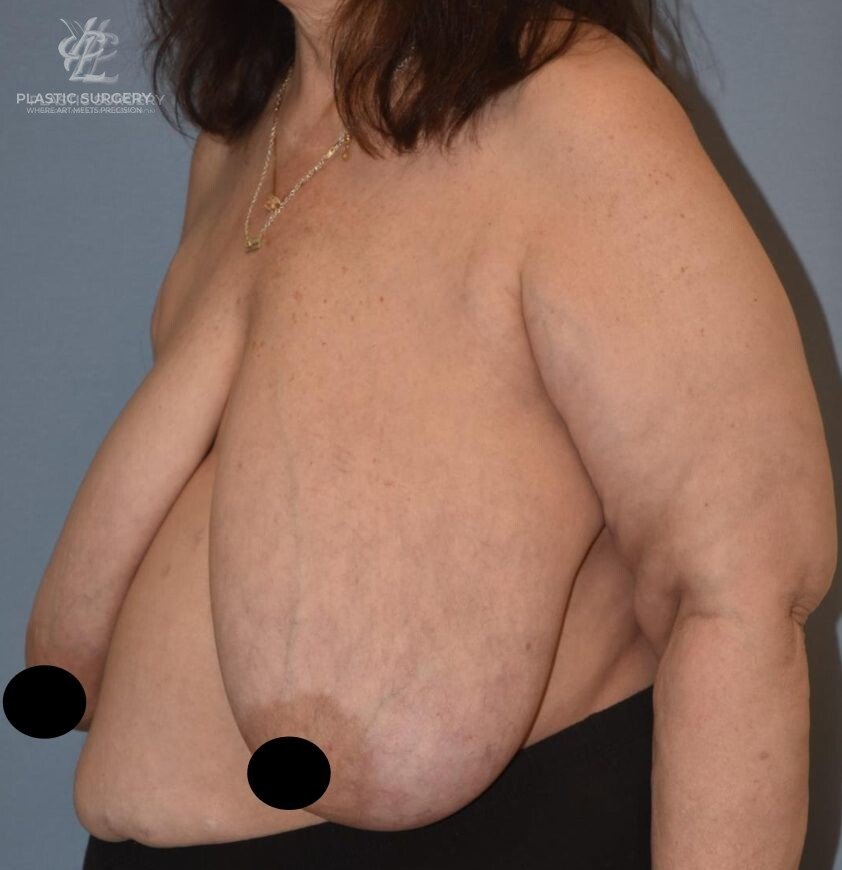 Breast Reduction, patient 5, before, view 2